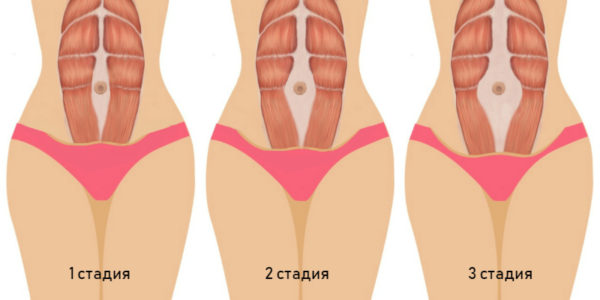 диастаз - стадии расхождения мышц
