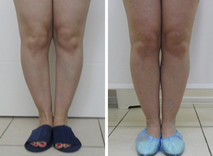 Круропластика ног. Пластика ног (круропластика). Круропластика (увеличение голени). Эндопротезирование голеней, или круропластика.