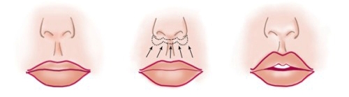 схема пластики губ