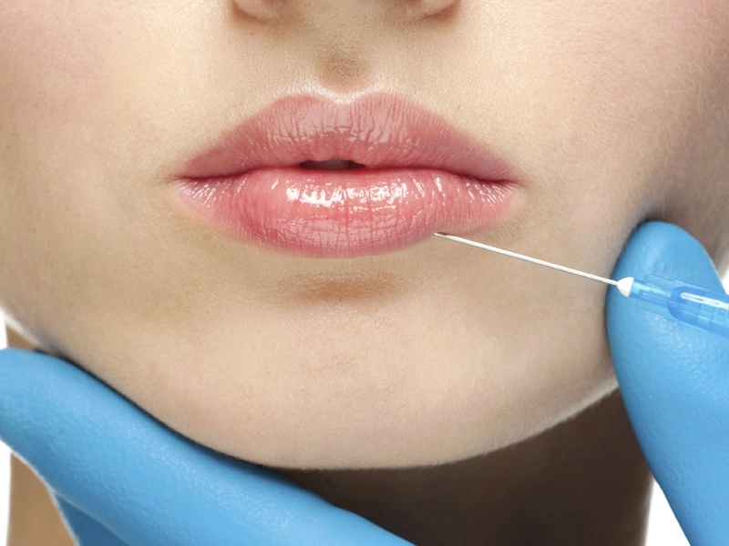 Сколько держится гиалуроновая кислота в губах?