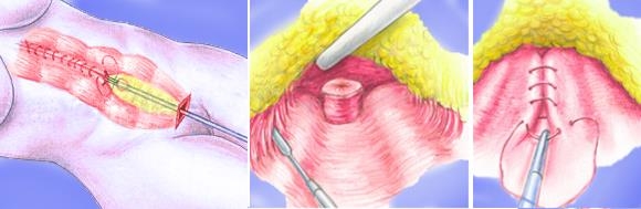 схема эндоскопической операции по ушиванию диастаза